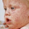 Measles vaccination health disease outbreak economics