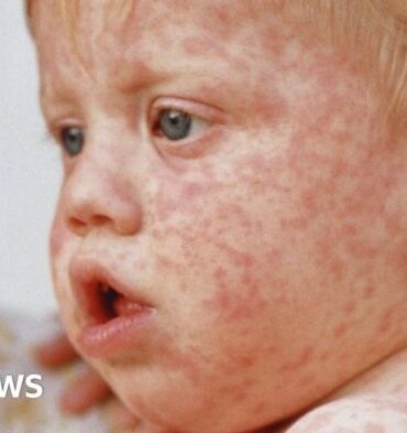 Measles vaccination health disease outbreak economics
