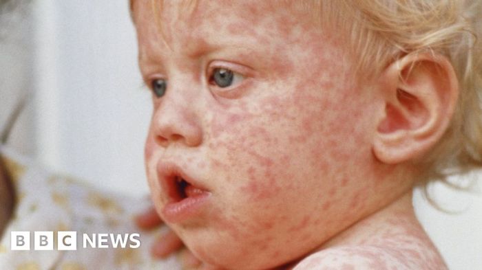 Measles vaccination health disease outbreak economics